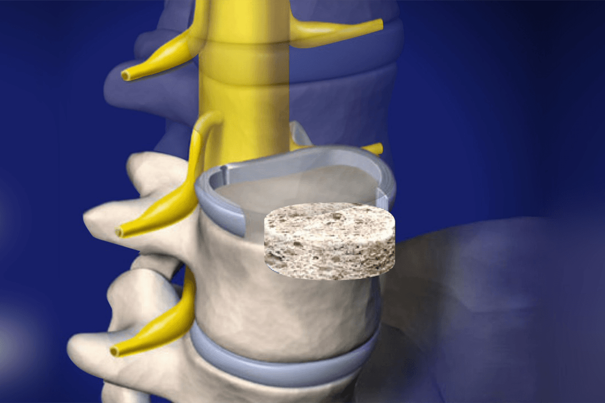 Anterior lumbar interbody fusion (ALIF) cage