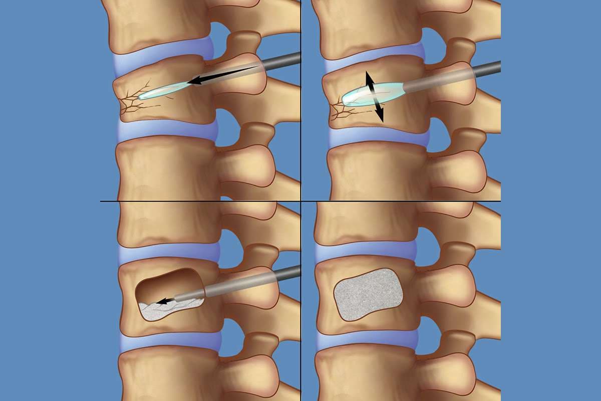 Kyphoplasty — balloon treatment of a vertebral fracture