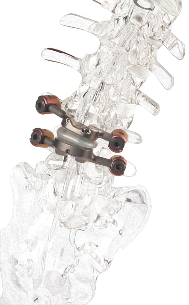 Implant de stabilisation dynamique TOPS en mouvement